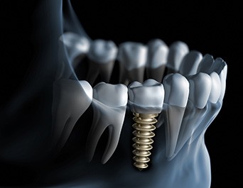 Graphic showing dental implant post in jawbone in Pleasanton